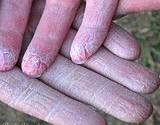 a photo of dry skin on hands a sign of Vitamin A deficiency