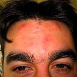 a photo of acne on a guys forhead sign of Vitamin A deficiency