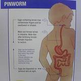 photo of a boy with pinworms for discussion on parasite cleanse